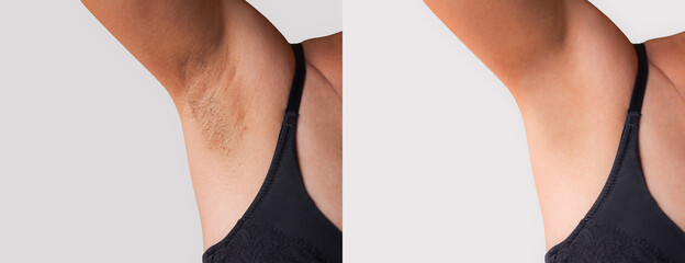 Image before and after skincare cosmetology armpits epilation treatment concept. Problem underarm...