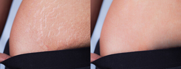 Image before and after skin stretch marks removal treatment on women abdomen after pregnancy .  - obrazy, fototapety, plakaty