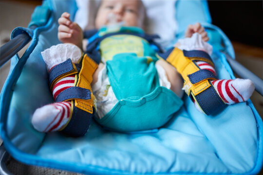 A Baby With A Harness That Corrects Hip Dysplasia