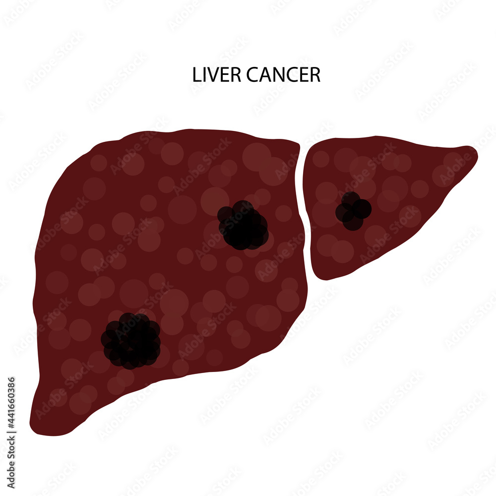 Canvas Prints Liver disease concept