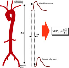 Pulse Wave Velocity (PWV) is a measure of arterial stiffness and is defined the velocity at which the blood pressure pulse wave propagates through the circulatory system - obrazy, fototapety, plakaty