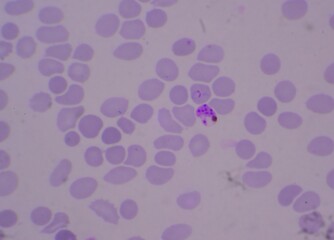 Blood parasite ring form Malaria infected red blood cells.