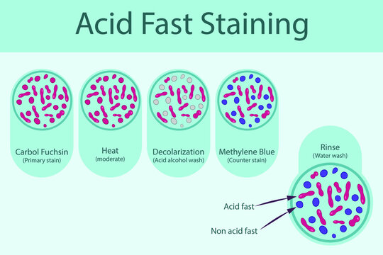 Acid fast staining technique steps diagram, using Carbol fuchsine and methylene blue vector illustration eps10