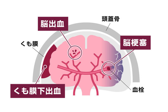 966 Best アルツハイマー Images Stock Photos Vectors Adobe Stock 966 Best アルツハイマー Images Stock Photos Vectors Adobe Stock