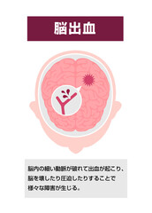 脳出血の原因と症状　図解ベクターイラスト