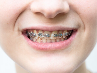 front view of orthodontic dental braces on teeth of upper jaw of girl closeup