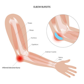 Student elbow bursitis