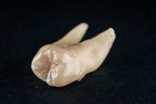 Real Wisdom Tooth Bone with Roots Pulled by Dentist