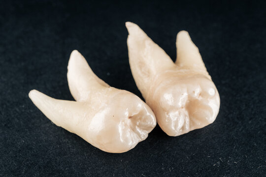 Real Wisdom Teeth Bones with Roots Pulled by Dentist