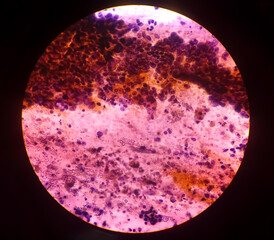 Photomicrograph showing adenocarcinoma of gallbladder. Gallbladder cancer, 40x