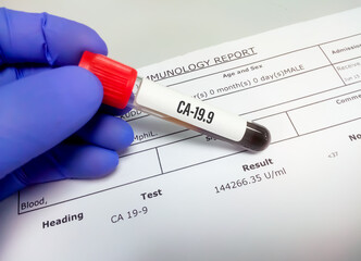 Doctor hand hold blood sample with abnormal CA 19.9 report, tumor marker for pancreatic cancer