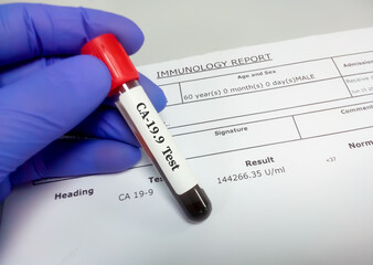 Scientist hold blood sample for with abnormal CA 19.9 report, tumor marker for pancreatic cancer
