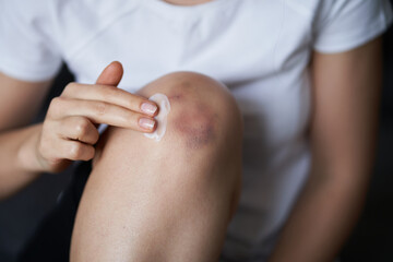 Close up of a person rubbing cream for healing injured knee joint. Bruise on the knee. Leg pain