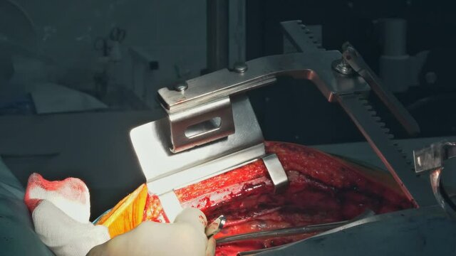 Process surgery operation of trauma using medical equipment in operating room