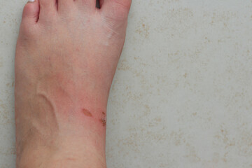 close up of a Woman's left foot with Bloody Wounds caused by corns. Problem of many people after wearing a new sandals in summer. 