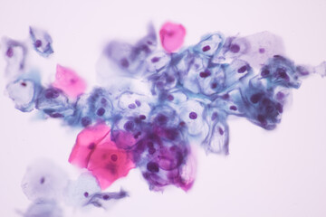 View in microscopic of koilocyte cell criteria of HPV (Human Papilloma virus) infection.Pap smear for woman.Medical background concept. - obrazy, fototapety, plakaty