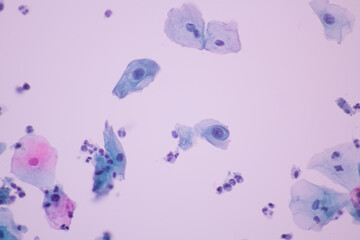 View in microscopic of Abnormal human cervix cells.Squamous epithelium cells.Superficial and intermediate epithelial cells.Cytology and pathology laboratory department.Magnification 400 X