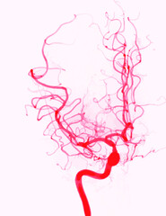 cerebral angiography or angiogram of internal carotid artery - obrazy, fototapety, plakaty