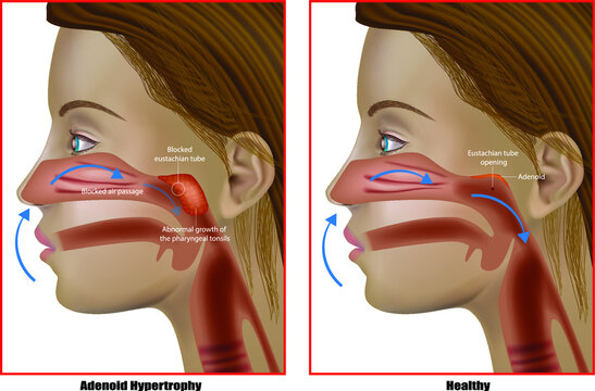 Adenoid hypertrophy, the abnormal growth of the pharyngeal tonsils. Adenoidectomy or Adenoid Removal. Eustachian Tube Dysfunction