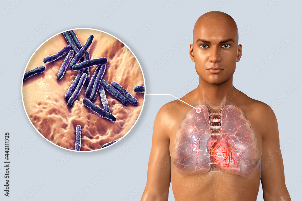 Sticker Lung tuberculosis and close-up view of bacteria Mycobacterium tuberculosis