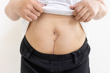 子宮筋腫でお腹を切った手術の傷跡、手術後10週間（女性、日本人、30代）