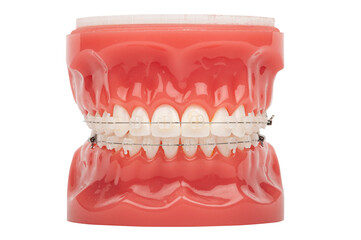 Orthodontic model demonstration teeth model of orthodontic bracket or brace. Ceramic braces on...