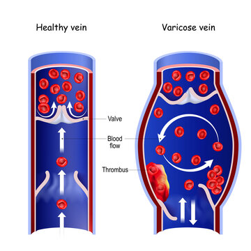 Healthy vein, and varicose vein. Cross section of a blood vessel 