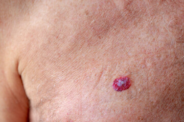 Health care concept, Close up a european senior man with red spot on the right chest, Basal-cell carcinoma (BCC) also known as basal-cell cancer is the most common type of skin cancer.