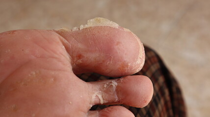 Peeling skin, rash on the feet, must be treated with medicine.

