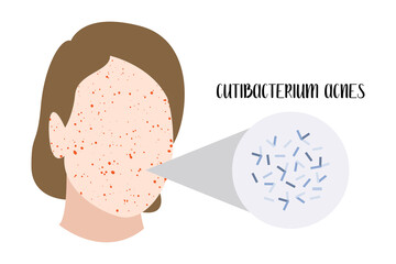Cutibacterium acnes, Propionibacterium. Gram-positive bacteria. Acne, inflammatory skin disease, skin rashes and pimples on face, allergy. Dermatology. Vector flat cartoon illustration