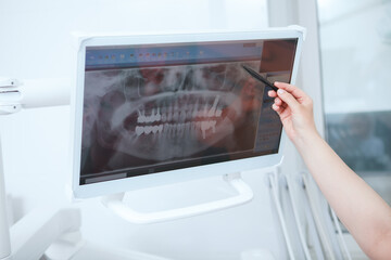Cropped shot of female dentist pointing at dental x-ray scan on computer screen