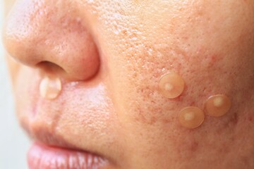 Acne pimple patch to get rid of zits on face