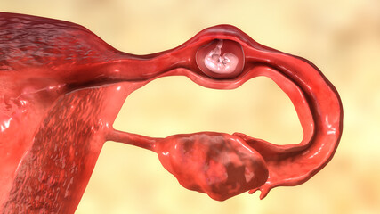 Tubal ectopic pregnancy, 3D illustration - obrazy, fototapety, plakaty