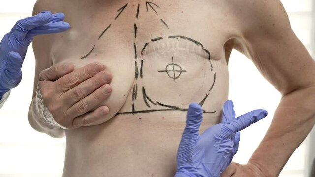 Preparing for breast reconstruction for a woman undergoing mastectomy. Breast plastic surgery after mastectomy.
