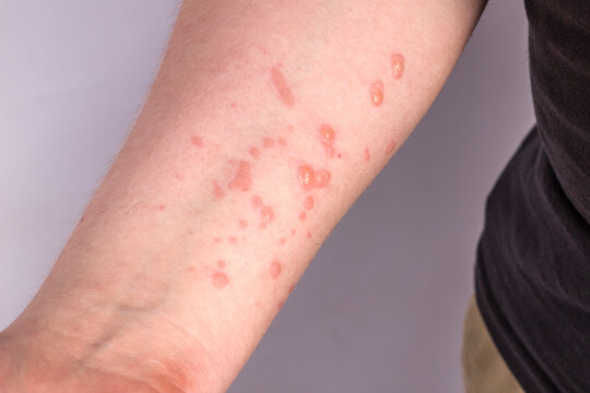 Large rash on the guy's hand. Monkeypox virus