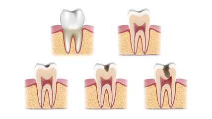 A schematic sectional view of the stages of caries development on a tooth