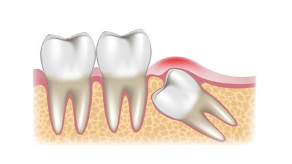 A schematic sectional view of a growing wisdom tooth