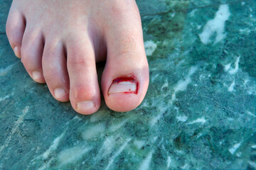 Damage to the nail plate on the leg. Big toe injury, nail torn off and blood flowing.