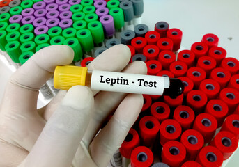Blood sample for Leptin test. This test measures the amount of leptin in the blood to detect a deficiency that may be contributing to obesity.