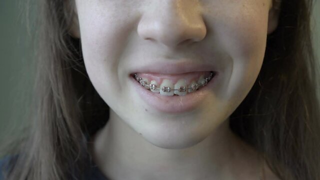 Close - up of the mouth of a young girl with braces, who smiles widely and shows her teeth with metal braces. Concept. 4k.