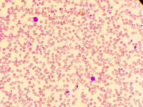 Iron deficiency Hypochromic microcytic anemia, red blood cells in a peripheral blood smear,thrombocytocis