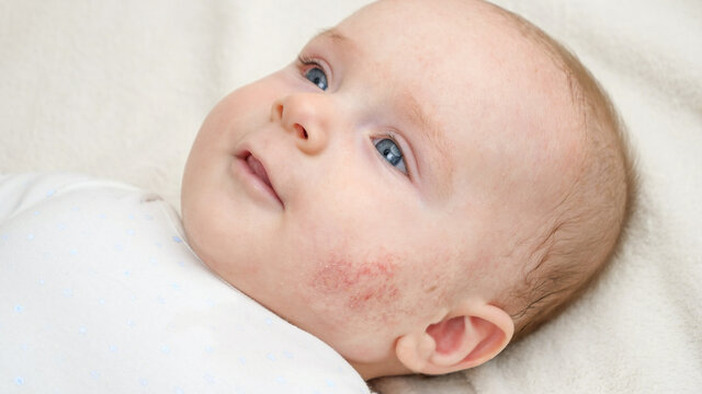 Portrait Of Cute Little Baby With Red Skin Suffering From Acne Or Dermatitis. Concept Of Newborn Baby Hygiene, Health And Skin Care