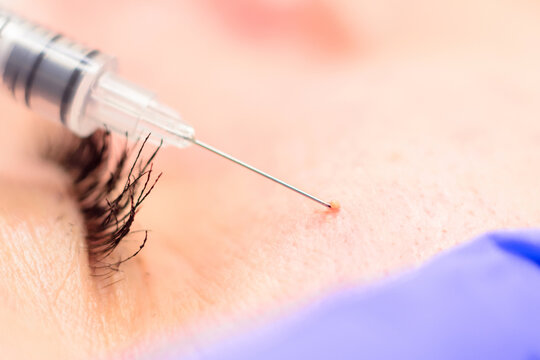 Removal of milia on the face with a syringe, cosmetic procedure on the face.