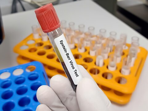 Test Tube with blood sample for Epstein-Barr virus test. A medical testing concept in the laboratory background.