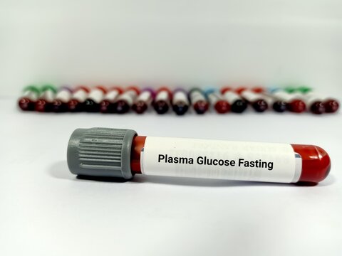 Blood sample for Plasma glucose Fasting (FGP) test. Fasting blood sugar (FBS) for diagnosis hyperglycemia or hypoglycemia in Diabetes Mellitus (DM). A medical testing concept with various test tubes.