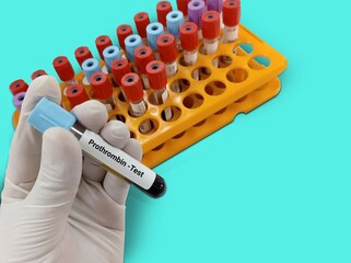 Biochemist or Lab Technologist holds Blood samples for Prothrombin time (PT). Blood coagulation...