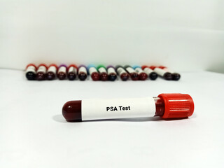 Blood sample for PSA test.  Doctor or Scientist holding tube for Prostate Specific Antigen test in the Laboratory Background