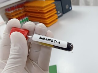 Biochemist or Lab Technologist holds Blood samples for  Anti MPO test, cANCA, diagnosis of...
