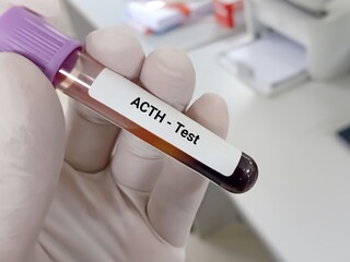 Biochemist or Lab Technologist holds Blood sample for Adrenocorticotropic hormone (ACTH) test, diagnosis of Addison's disease with laboratory background.