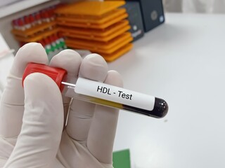 Biochemist or Lab Technologist holds Blood sample for HDL (High-density lipoprotein) test. Lipid profile. Good Cholesterol. Medical testing concept.